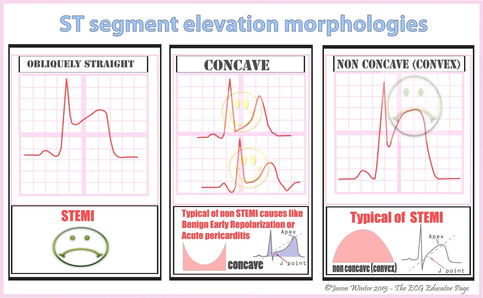 ECG Educator Blog ST Segment Elevation Morphologies